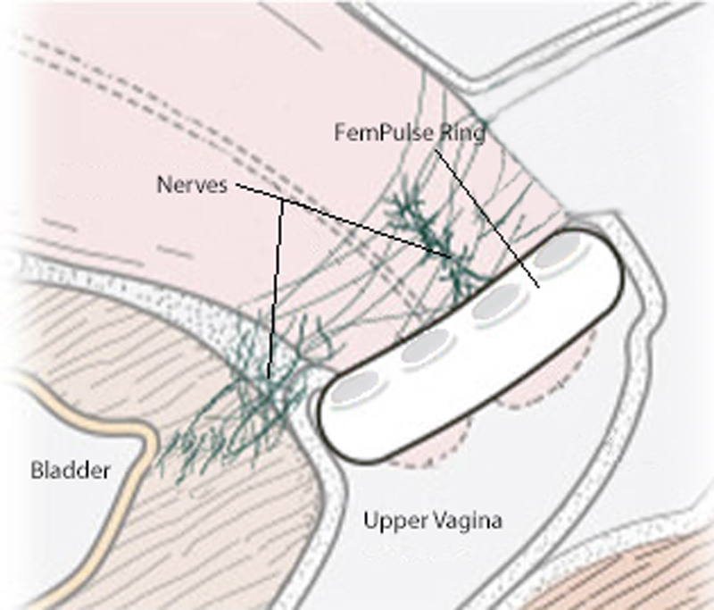 Drawing of the FemPulse Device Inside a Woman